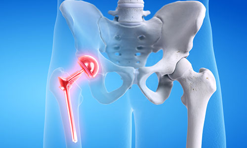 Hip replacement surgery in vijayawada